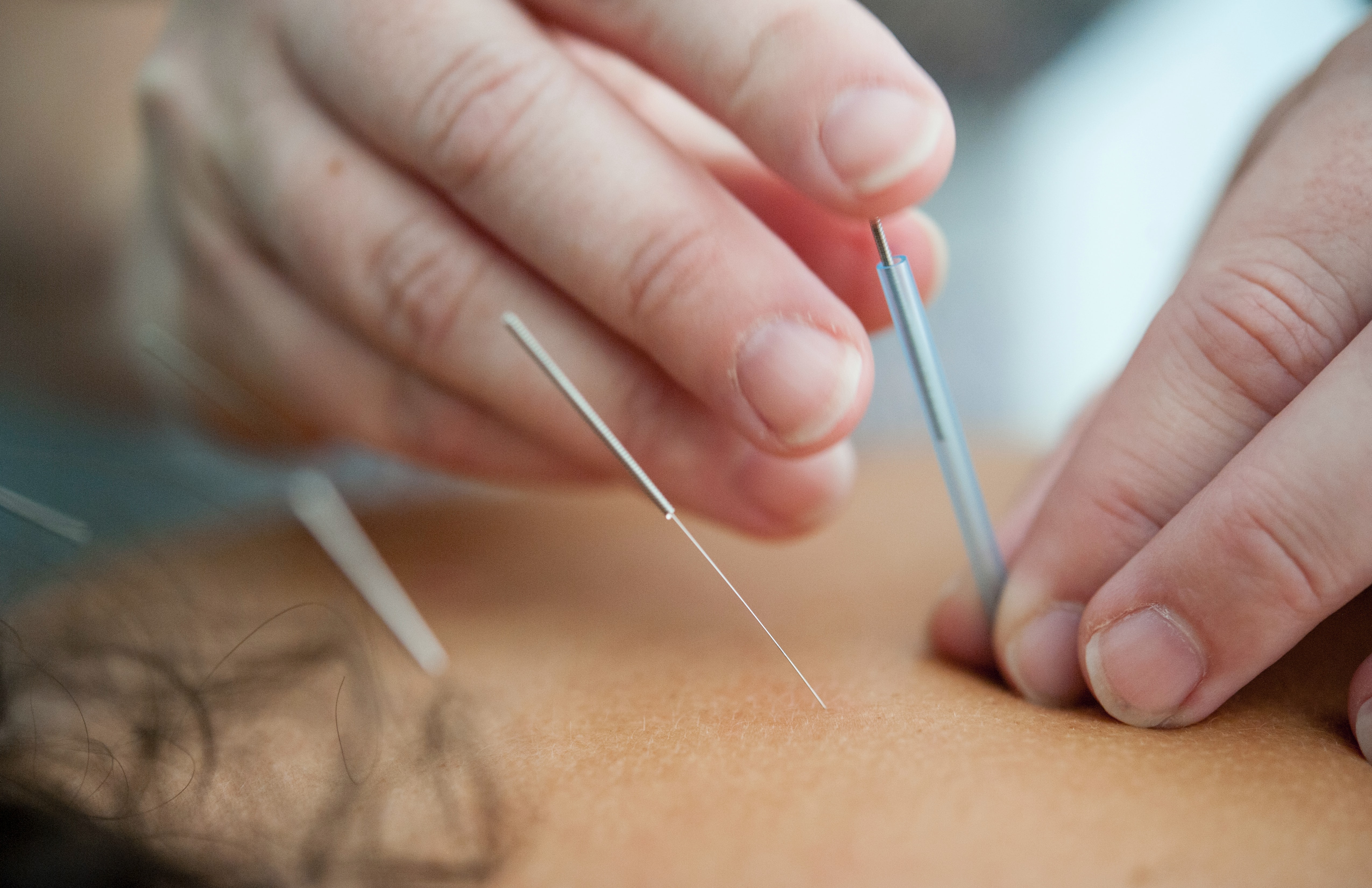 Spinal Acupuncture